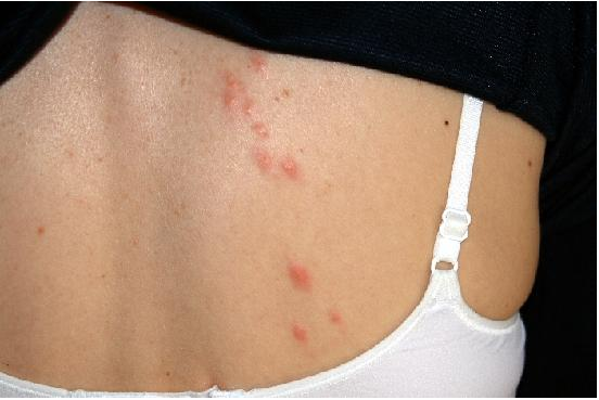 flea bites